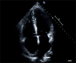 echocardiogram image