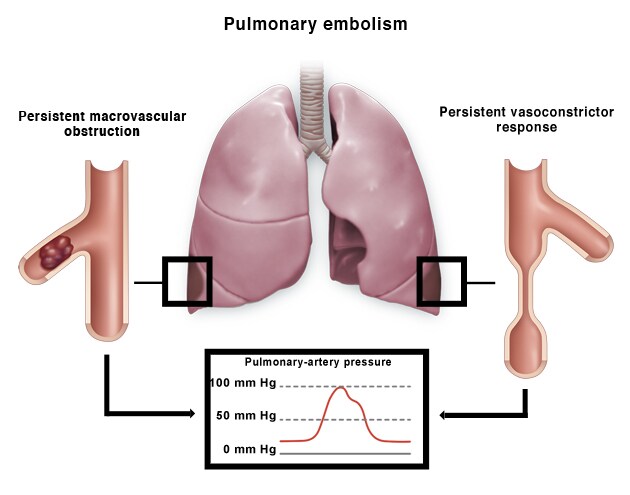 pulmonary embolism graphic