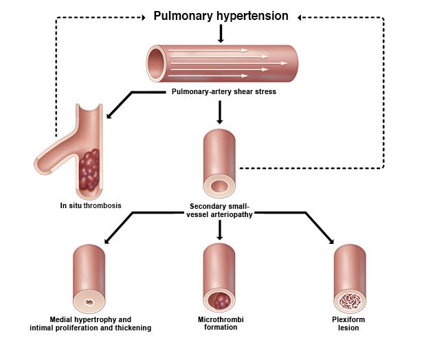 pulmonary hypertension graphic