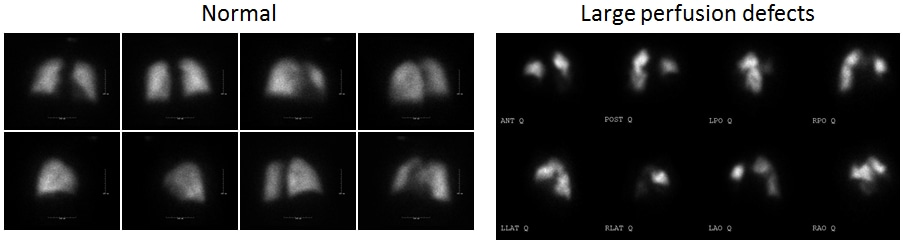 V/Q scan image