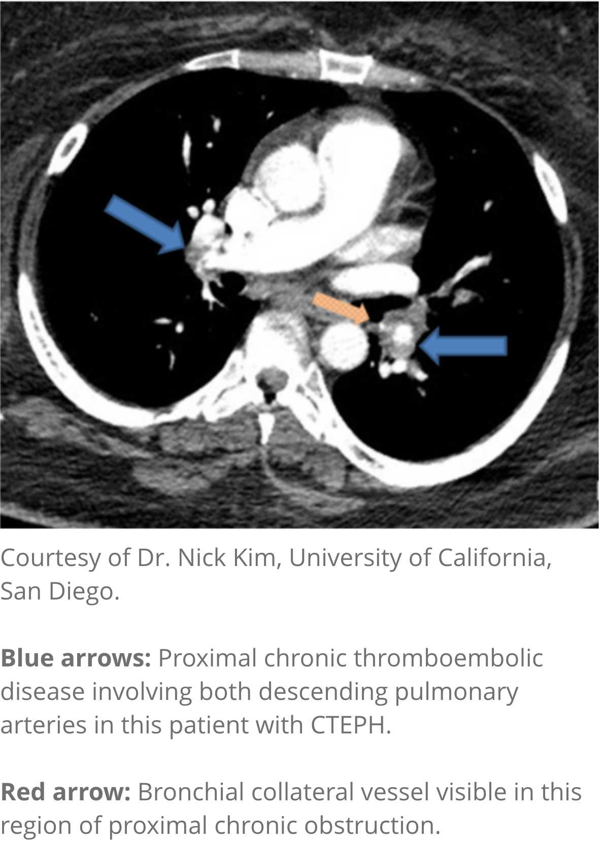 CT angiography image