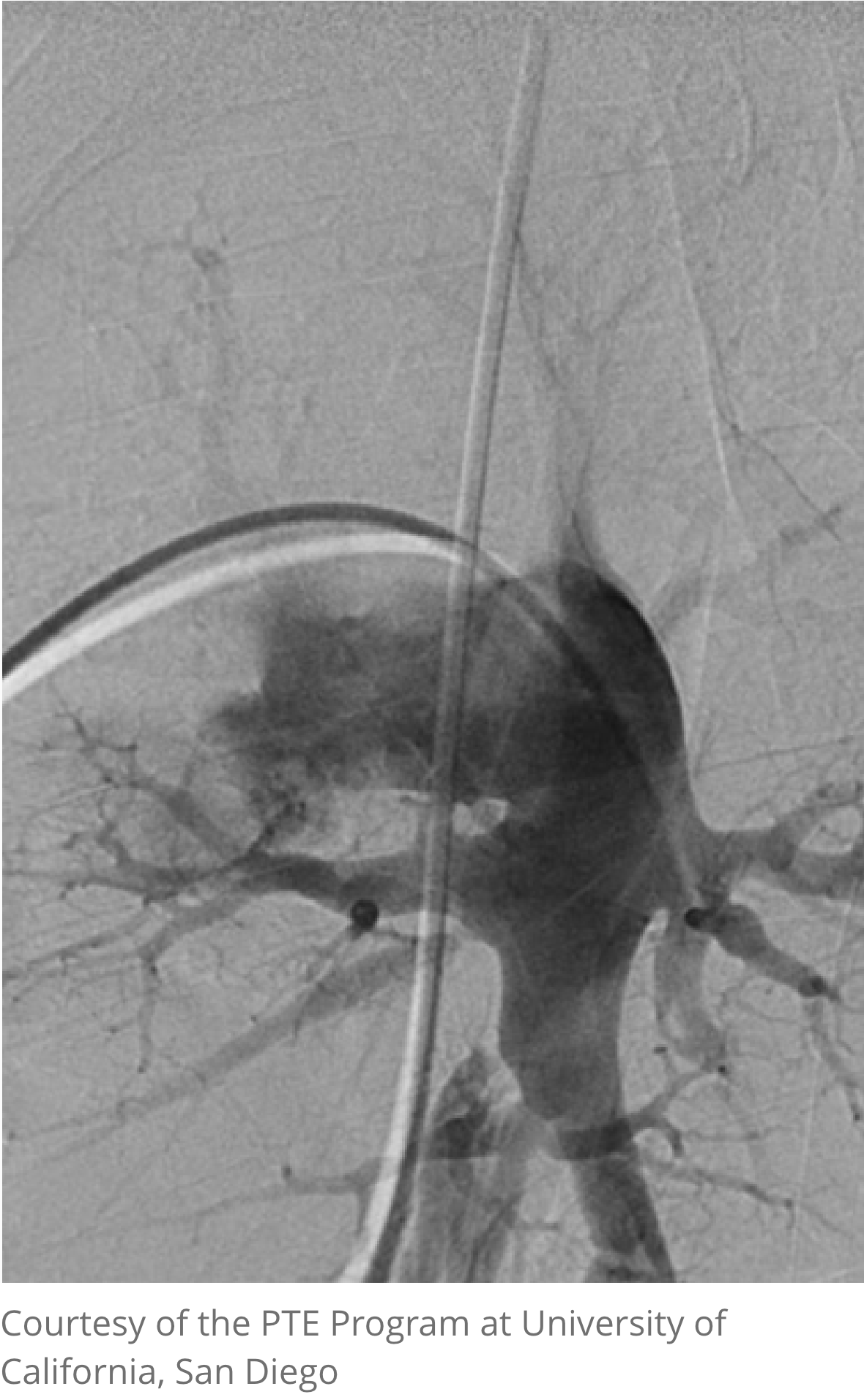 pulmonary angiography image