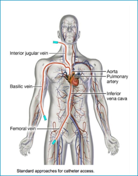 Standard approaches for catheter access image