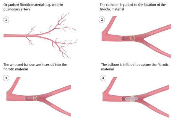 BPA Balloon pulmonary angioplasty BPA Balloon pulmonary angioplasty
