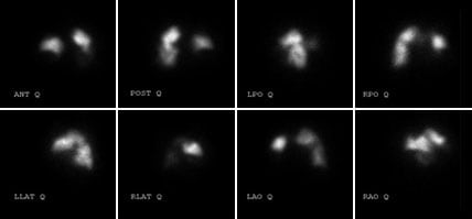 Positive V/Q scan image Positive V/Q scan image