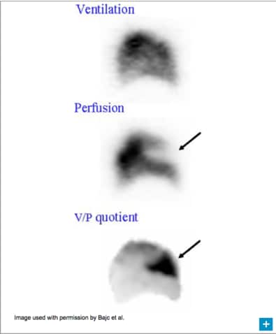 PE defect image PE defect image