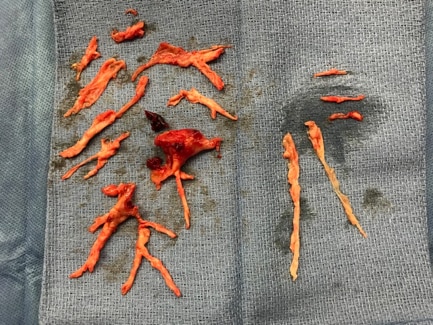 pulmonary thromboendarterectomy image pulmonary thromboendarterectomy image