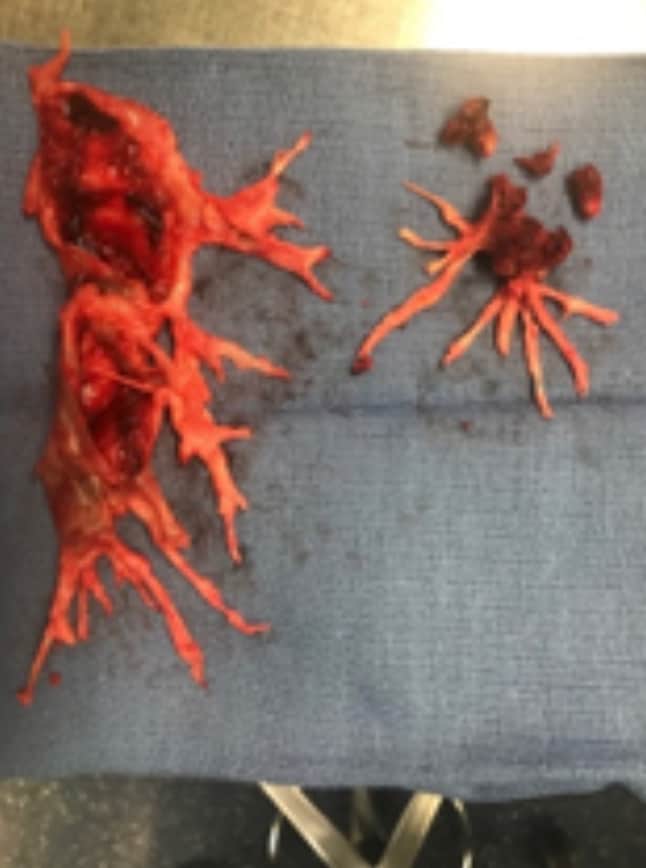 pulmonary thromboendarterectomy image pulmonary thromboendarterectomy image