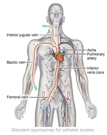 Right Heart Catheterization Graphic Right Heart Catheterization Graphic