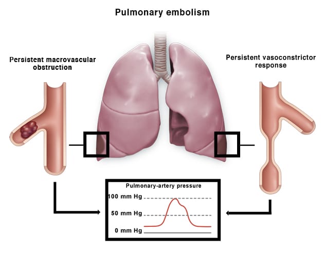 pulmonary embolism graphic pulmonary embolism graphic