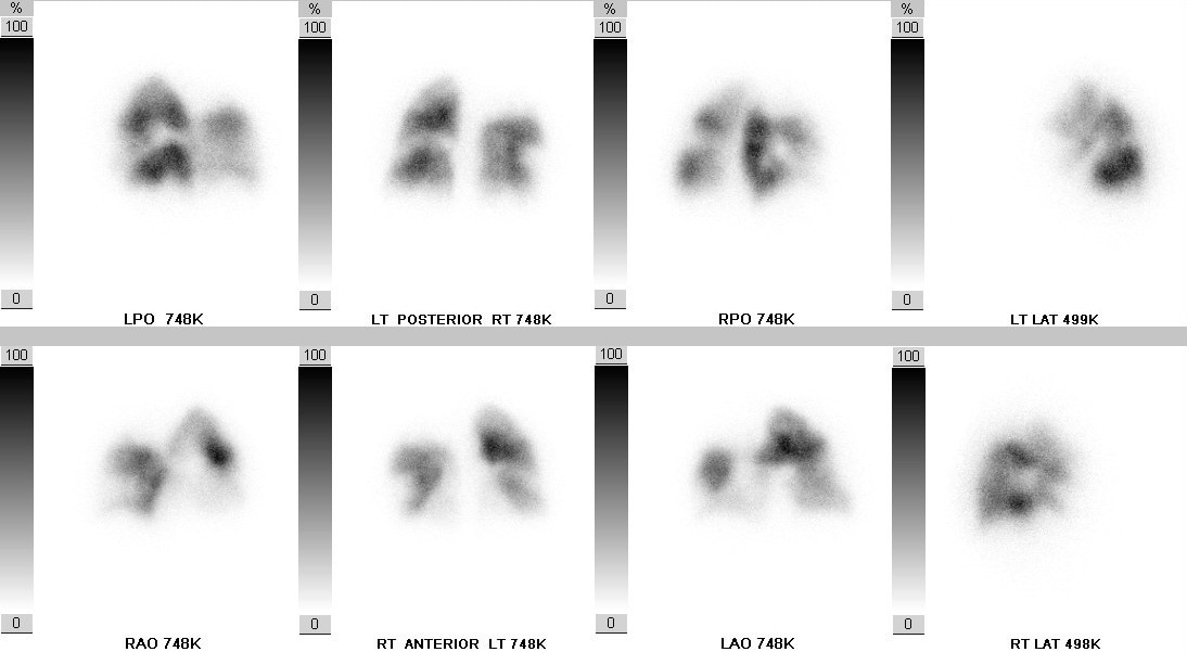 V/Q scan image V/Q scan image
