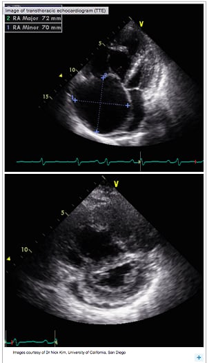 Transthoracic echocardiogram image Transthoracic echocardiogram image