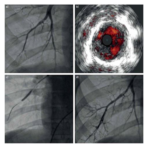 balloon pulmonary angioplasty image