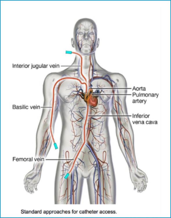 Standard approaches for catheter access image